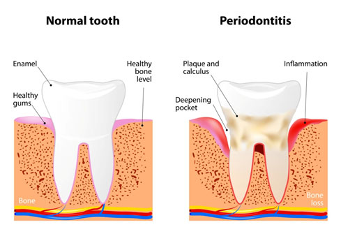 Gum Disease Corsicana, Mansfield, Seagoville and Waxahachie