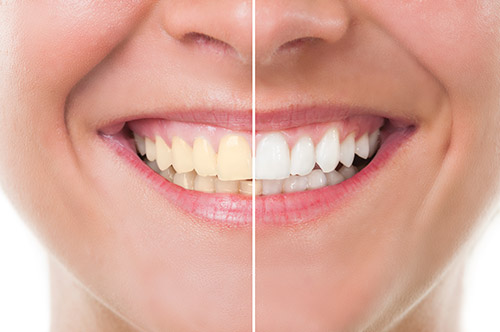 Professional Teeth Whitening Corsicana, Mansfield, Seagoville, Waxahachie