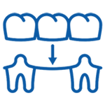 Three dental crowns above two teeth with downward arrow indicating placement procedure.